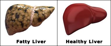fatty-healthy-liver.jpg