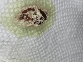 Blood in poop? HELP.