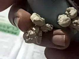 Budgie with huge calcified growths on feet