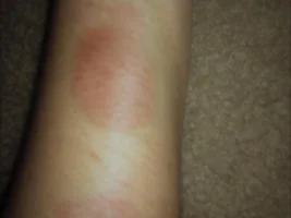 Bite pics (welcome home mom!)