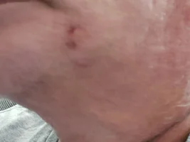 Bad bite from Bingo.