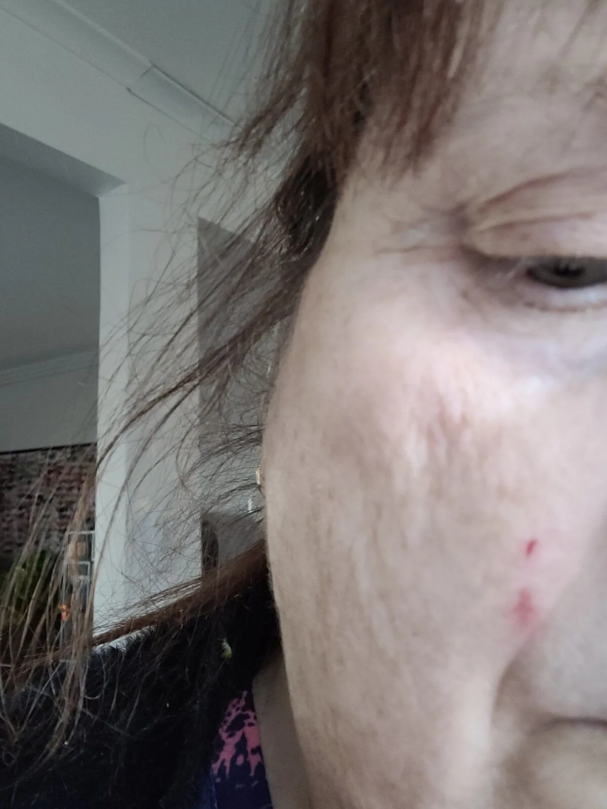 War wound - and pride wound too